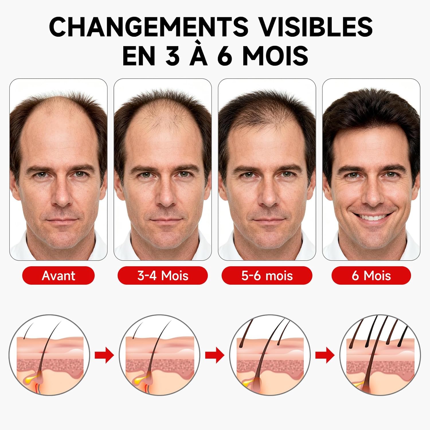 Casque LED Cheveux,Casque Pousse Cheveux,7 Modes Casque De Croissance De Cheveux 660nm+850nm, Sans fil Casque Anti Calvitie,Accélérer La Croissance Des Cheveux pour Femme Homme