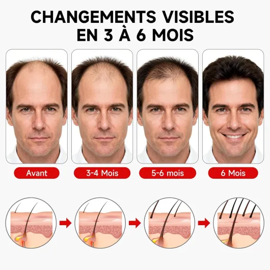 Casque LED Cheveux,Casque Pousse Cheveux,7 Modes Casque De Croissance De Cheveux 660nm+850nm, Sans fil Casque Anti Calvitie,Accélérer La Croissance Des Cheveux pour Femme Homme